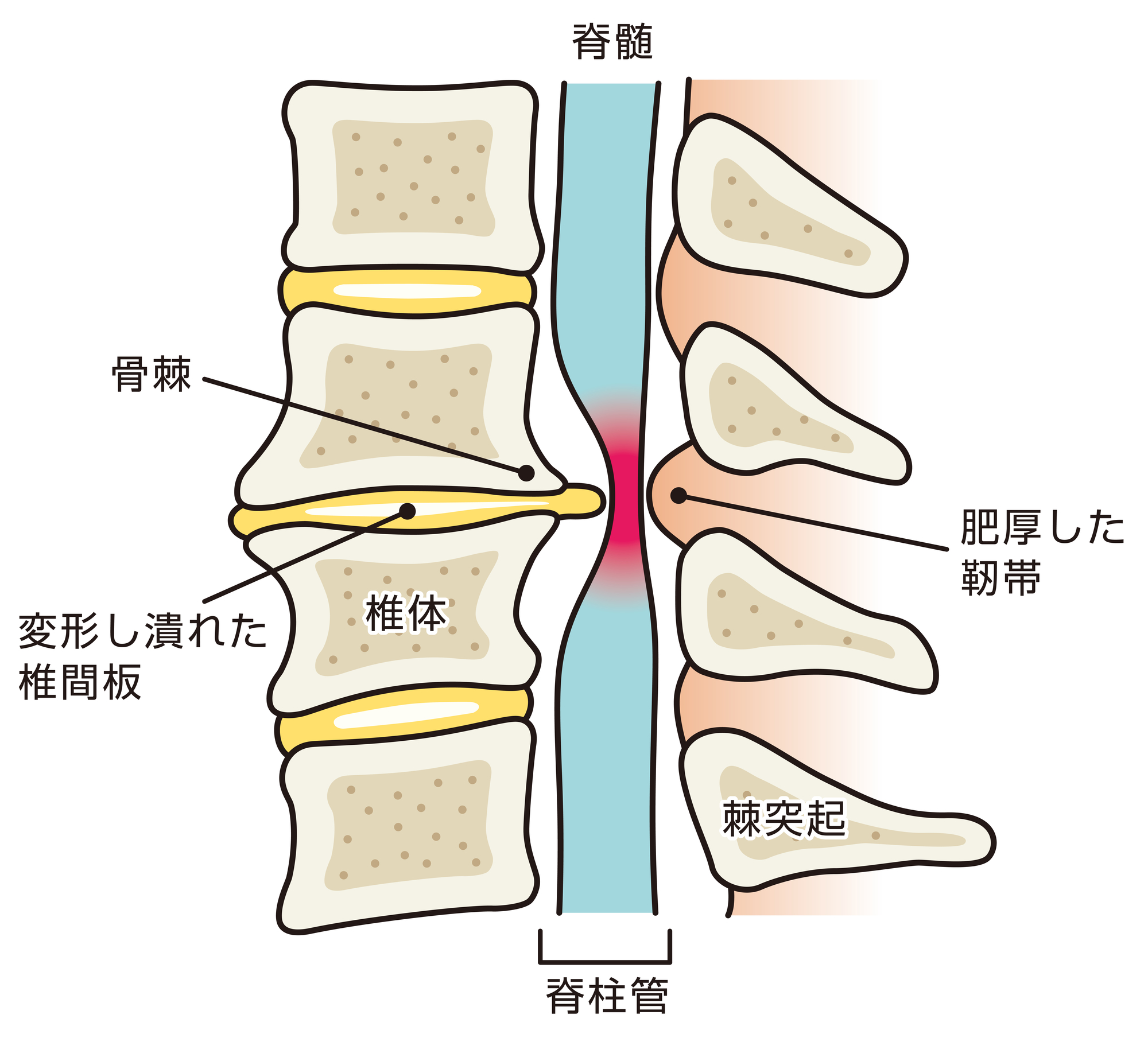 変形性腰椎症とは｜蒲田の腰痛専門治療院